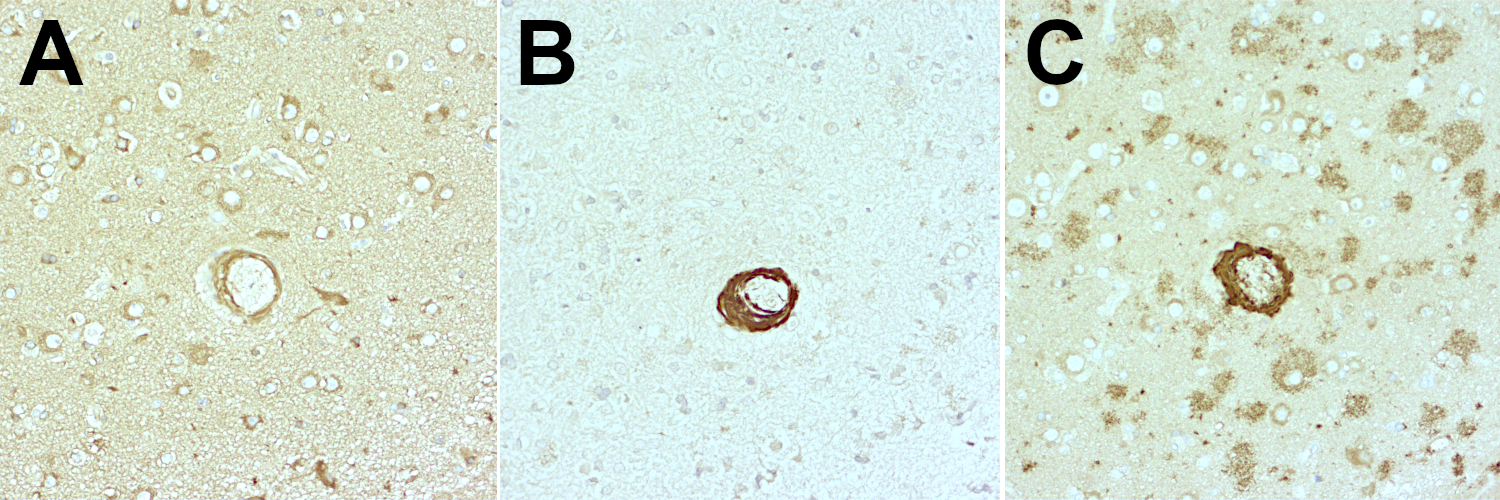 Formalin fixed paraffin embedded (FFPE) human brain sections from an Alzheimer's patient were stained with mouse anti-Abeta38/40/42/43 (cat. no. 218 211, dilution 1:1000, DAB, brown) following Antigen Retrieval (AR) in Citrate buffer (Agilent, S1699) alone (A), combination of AR and digestion with proteinase K (B) or combination of AR and FA treatment (C). Nuclei have been visualized by hematoxylin staining (blue).
