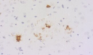 Neuroinflammation is the biological response of the central nervous system (CNS) to harmful stimuli.